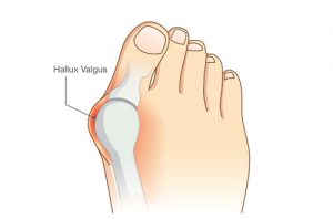 hallux valgus operation