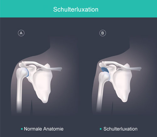 schulterluxation