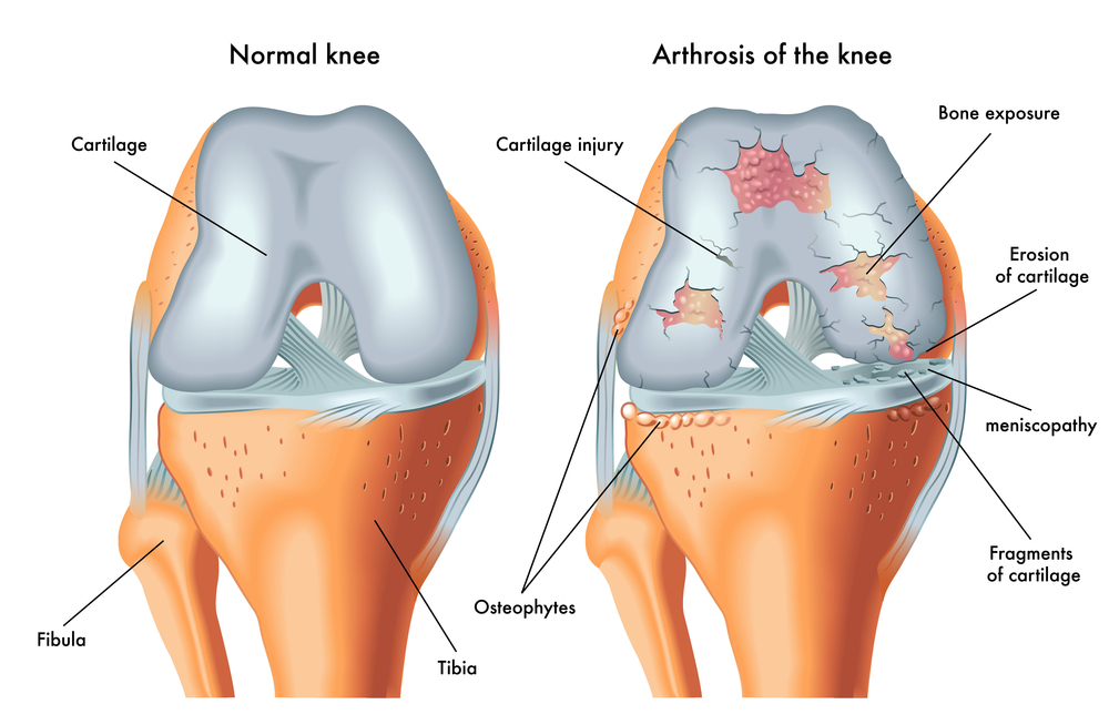 cartilage damage