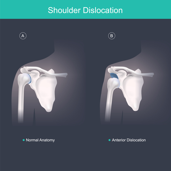 Shoulder Dislocation