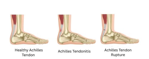 achilles tendon rupture