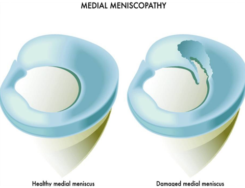 meniscopathy