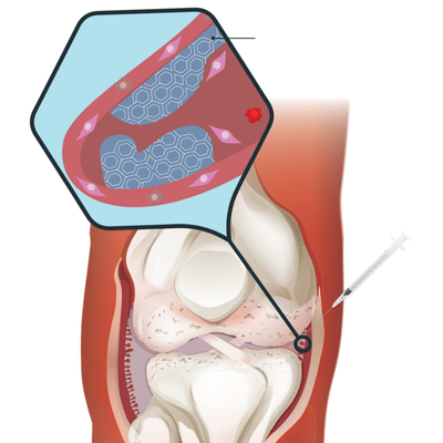 arthrosamid-kniearthrose ARTHROSAMID® bei Kniearthrose