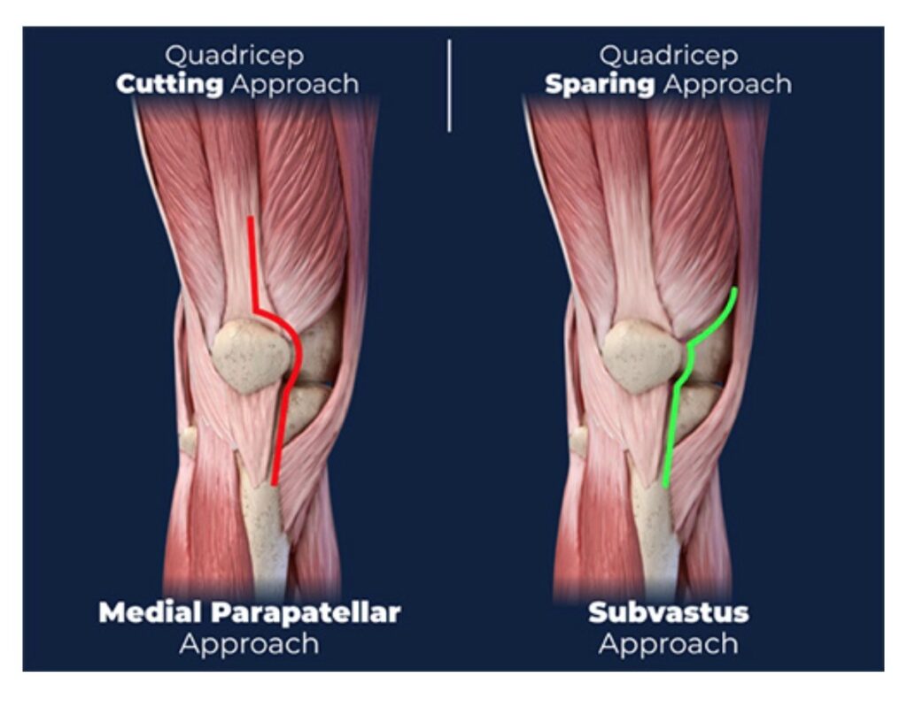 Subvastus Approach